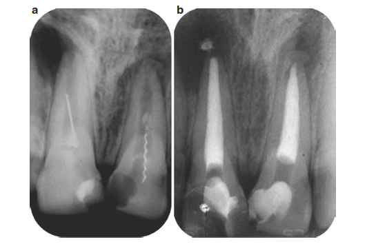 چه فاکتورهایی در شکست فایل در کانال دندان تاثیر می گذارند؟ 
