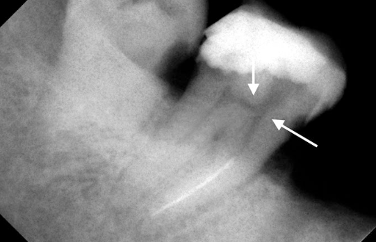 چه فاکتورهایی در شکست فایل در کانال دندان 12