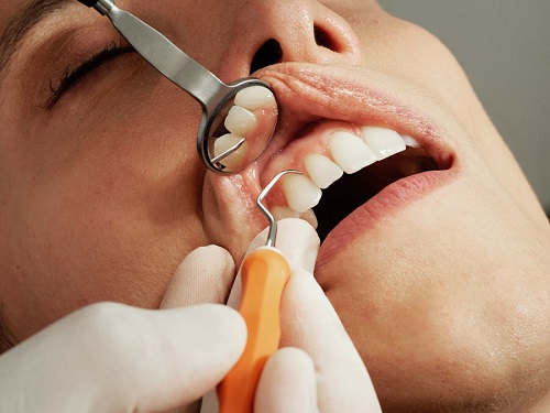 زخم‌های دهانی و سلامت دندان