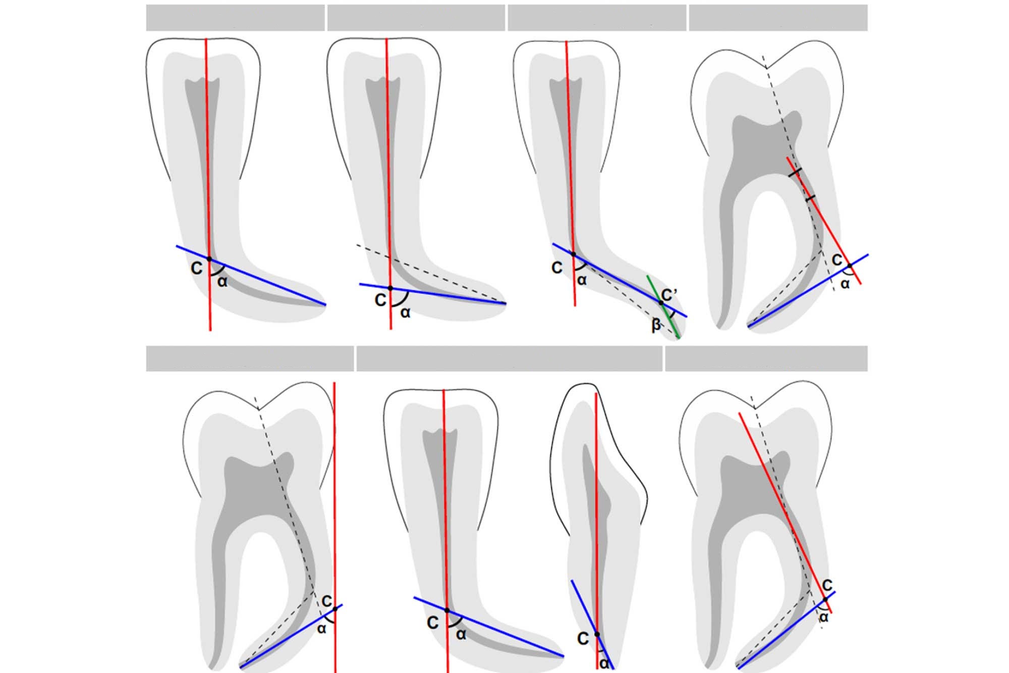 فاکتورهایی در شکست فایل در کانال دندان تاثیر 